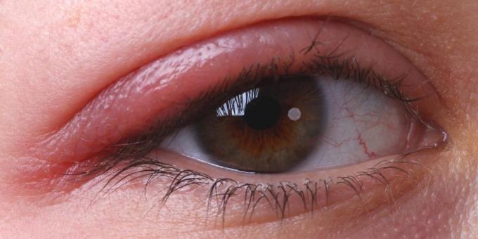 למה עיניים מגרדות: blepharitis