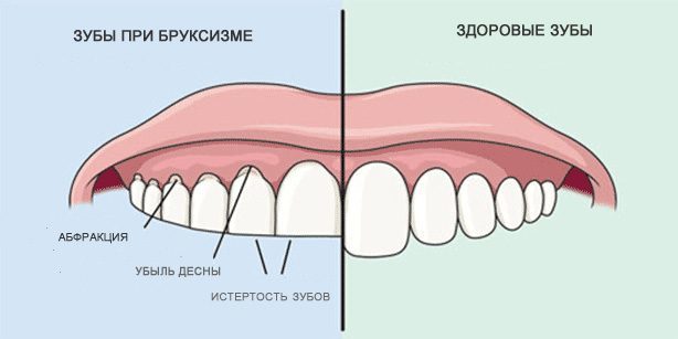חריקת שיניים: שיניים בריאות ושיניים במהלך bruxism
