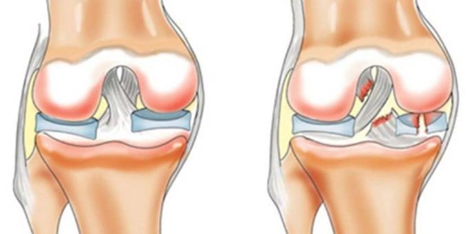 למה לפגוע ברכי: קדמי צולבות רצועת קרע