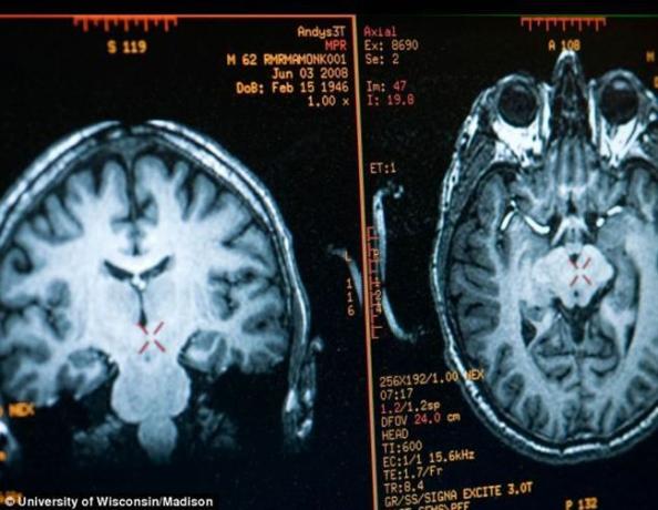 תמונת המוח מתייה ריקאר מתקבל על ידי MRI