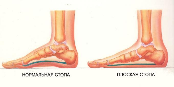 תרגילי רגליים שטוחות: רגל נורמלית שטוחה