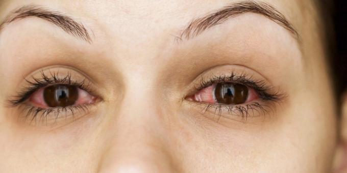 למה עיניים מגרדות, דלקת הלחמית