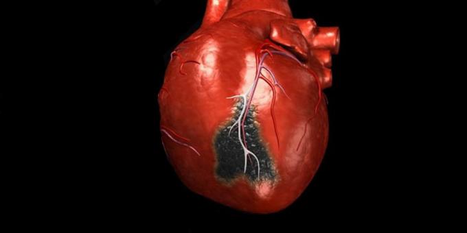 תסמינים של התקף לב, אשר אתה צריך להתקשר לאמבולנס