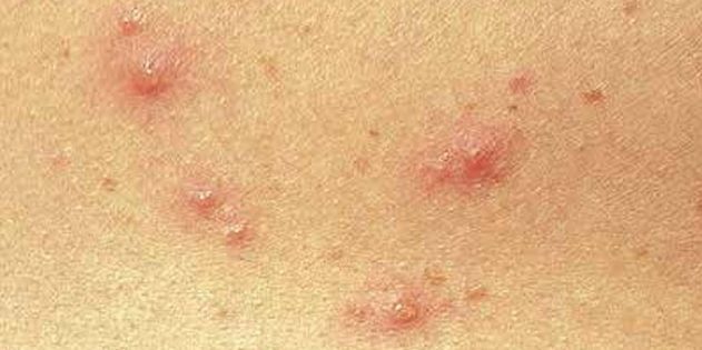 תסמינים של אבעבועות רוח אצל ילדים ומבוגרים: לעתים קרובות, העור מייד מופיעים נקודות אדומות קטנות